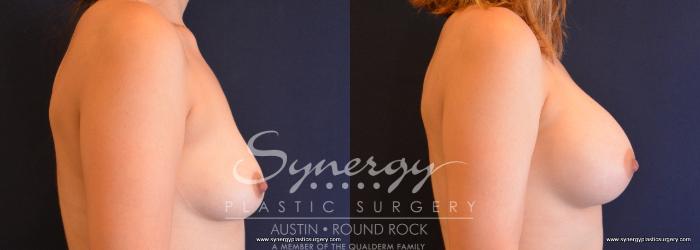 Before & After Breast Augmentation Case 650 View #5 View in Austin, TX