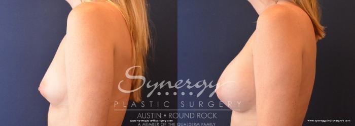 Before & After Breast Augmentation Case 653 View #2 View in Austin, TX