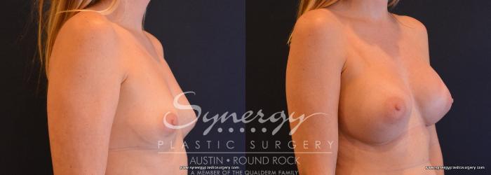 Before & After Breast Augmentation Case 653 View #3 View in Austin, TX