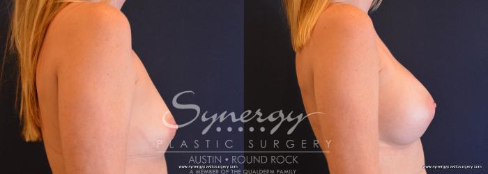 Before & After Breast Augmentation Case 653 View #5 View in Austin, TX