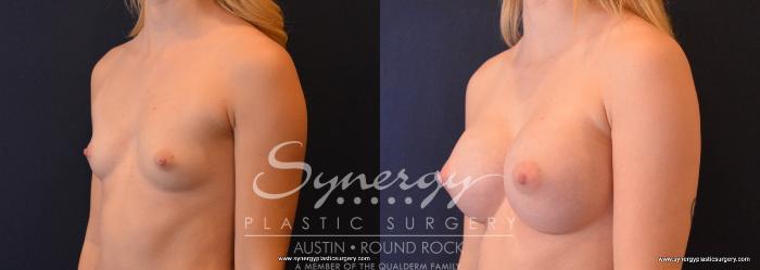 Before & After Breast Augmentation Case 654 View #2 View in Austin, TX
