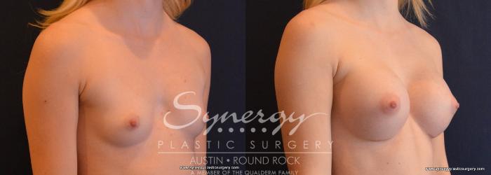 Before & After Breast Augmentation Case 654 View #4 View in Austin, TX