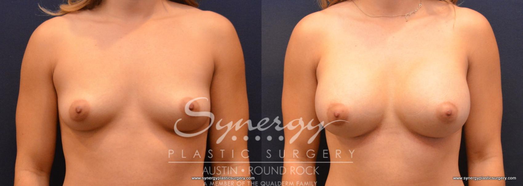 Before & After Breast Augmentation Case 657 View #1 View in Austin, TX
