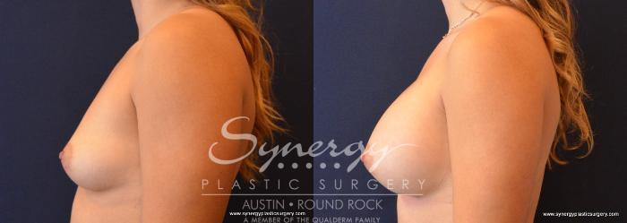 Before & After Breast Augmentation Case 657 View #3 View in Austin, TX