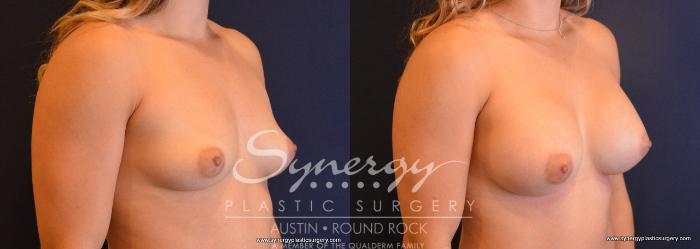 Before & After Breast Augmentation Case 657 View #4 View in Austin, TX