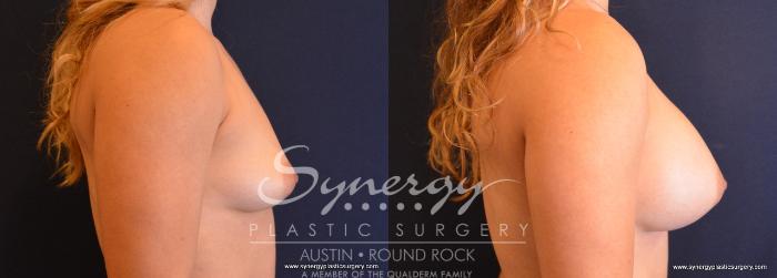 Before & After Breast Augmentation Case 657 View #5 View in Austin, TX