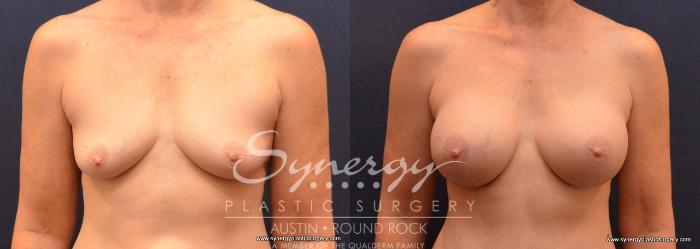 Before & After Breast Augmentation Case 659 View #1 View in Austin, TX