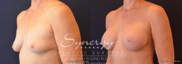 Before & After Breast Augmentation Case 659 View #2 View in Austin, TX