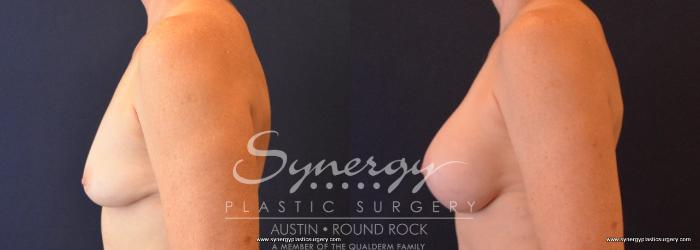 Before & After Breast Augmentation Case 659 View #3 View in Austin, TX