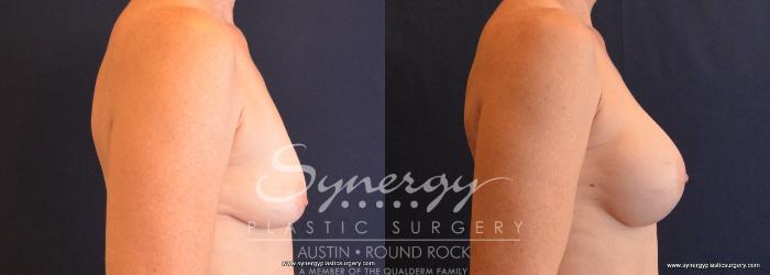 Before & After Breast Augmentation Case 659 View #4 View in Austin, TX
