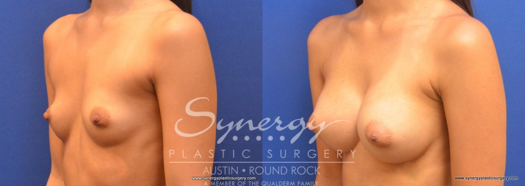 Before & After Breast Augmentation Case 662 View #1 View in Austin, TX