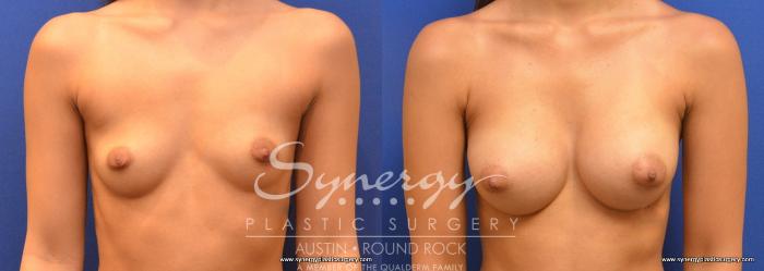 Before & After Breast Augmentation Case 662 View #2 View in Austin, TX