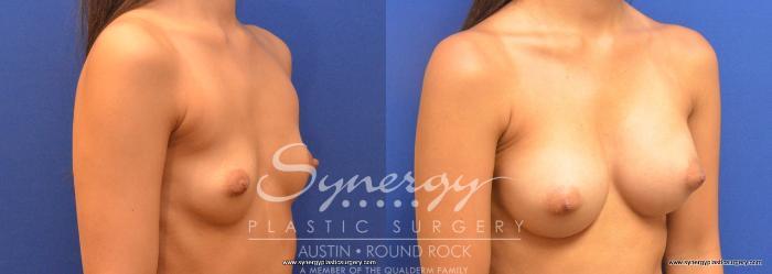 Before & After Breast Augmentation Case 662 View #3 View in Austin, TX