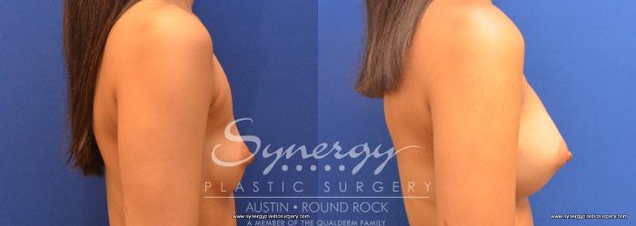 Before & After Breast Augmentation Case 662 View #4 View in Austin, TX