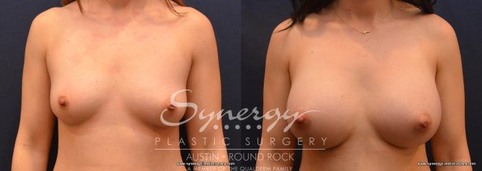 Before & After Breast Augmentation Case 663 View #1 View in Austin, TX