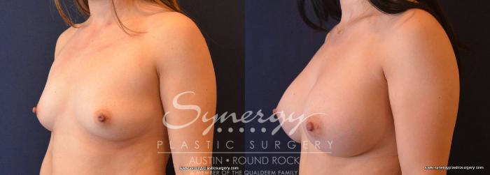 Before & After Breast Augmentation Case 663 View #2 View in Austin, TX