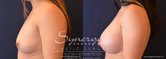 Before & After Breast Augmentation Case 663 View #3 View in Austin, TX