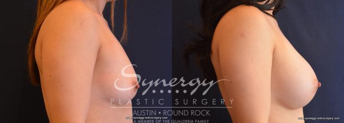 Before & After Breast Augmentation Case 663 View #4 View in Austin, TX