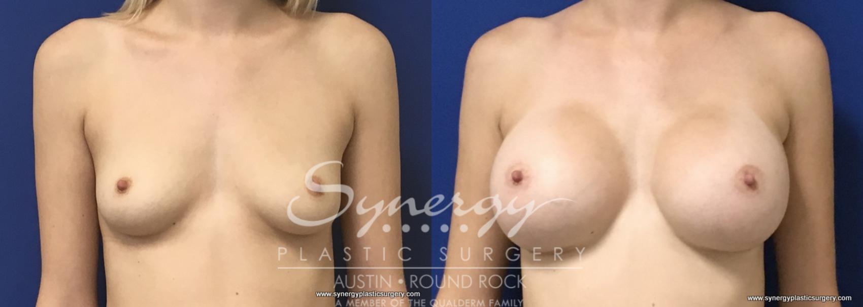 Before & After Breast Augmentation Case 664 View #1 View in Austin, TX