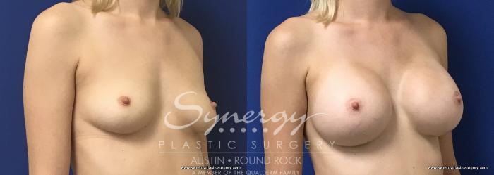 Before & After Breast Augmentation Case 664 View #2 View in Austin, TX