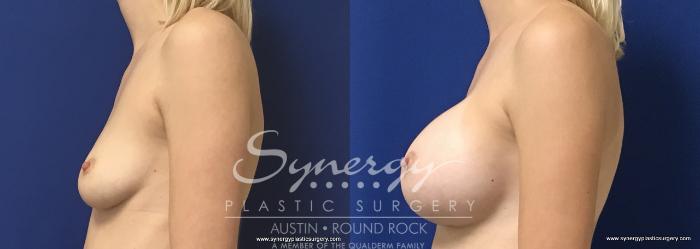Before & After Breast Augmentation Case 664 View #3 View in Austin, TX