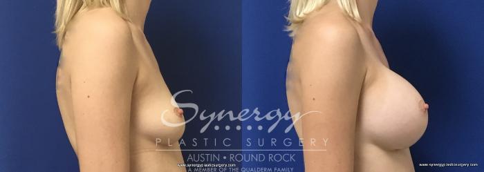 Before & After Breast Augmentation Case 664 View #5 View in Austin, TX