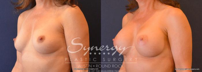 Before & After Breast Augmentation Case 665 View #2 View in Austin, TX