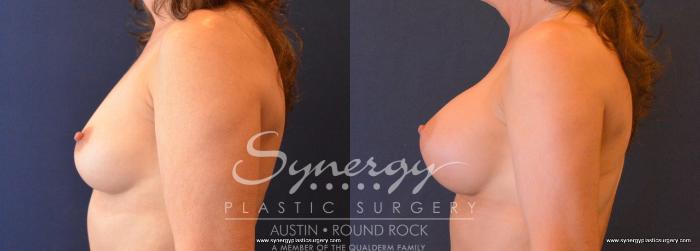 Before & After Breast Augmentation Case 665 View #3 View in Austin, TX