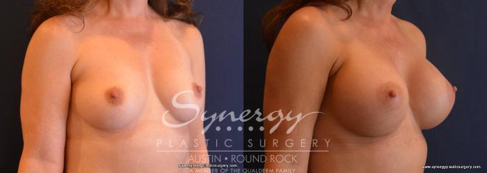 Before & After Breast Augmentation Case 665 View #4 View in Austin, TX