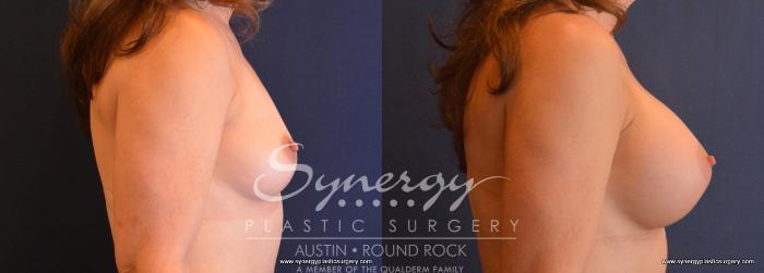 Before & After Breast Augmentation Case 665 View #5 View in Austin, TX