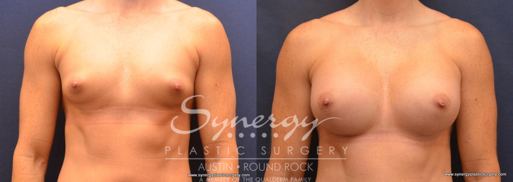 Before & After Breast Augmentation Case 666 View #1 View in Austin, TX
