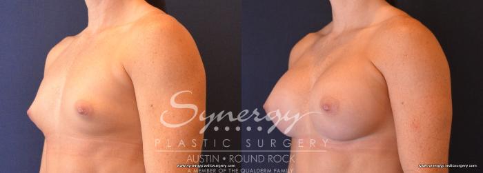 Before & After Breast Augmentation Case 666 View #2 View in Austin, TX