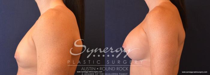 Before & After Breast Augmentation Case 666 View #3 View in Austin, TX