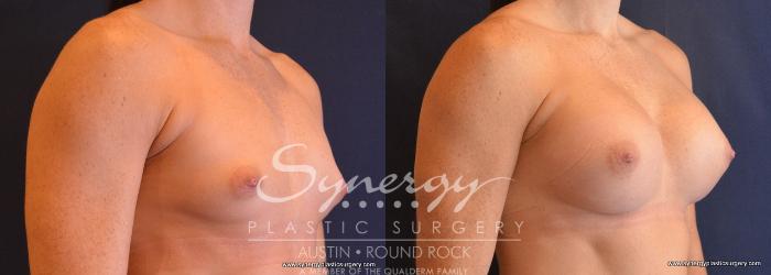 Before & After Breast Augmentation Case 666 View #4 View in Austin, TX