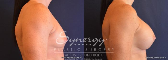 Before & After Breast Augmentation Case 666 View #5 View in Austin, TX
