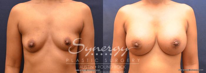 Before & After Breast Augmentation Case 668 View #1 View in Austin, TX