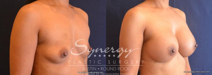 Before & After Breast Augmentation Case 668 View #2 View in Austin, TX