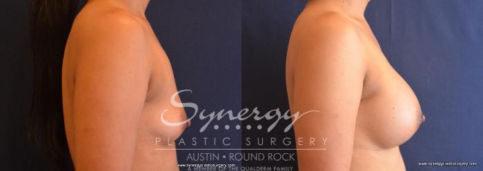 Before & After Breast Augmentation Case 668 View #3 View in Austin, TX