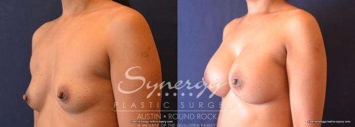 Before & After Breast Augmentation Case 668 View #4 View in Austin, TX