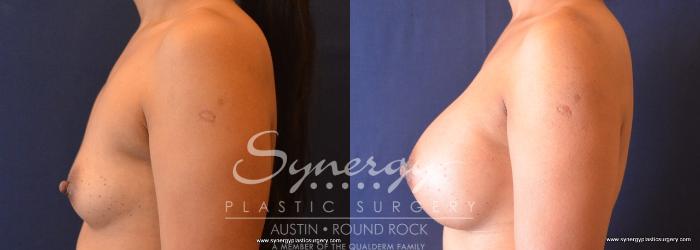 Before & After Breast Augmentation Case 668 View #5 View in Austin, TX