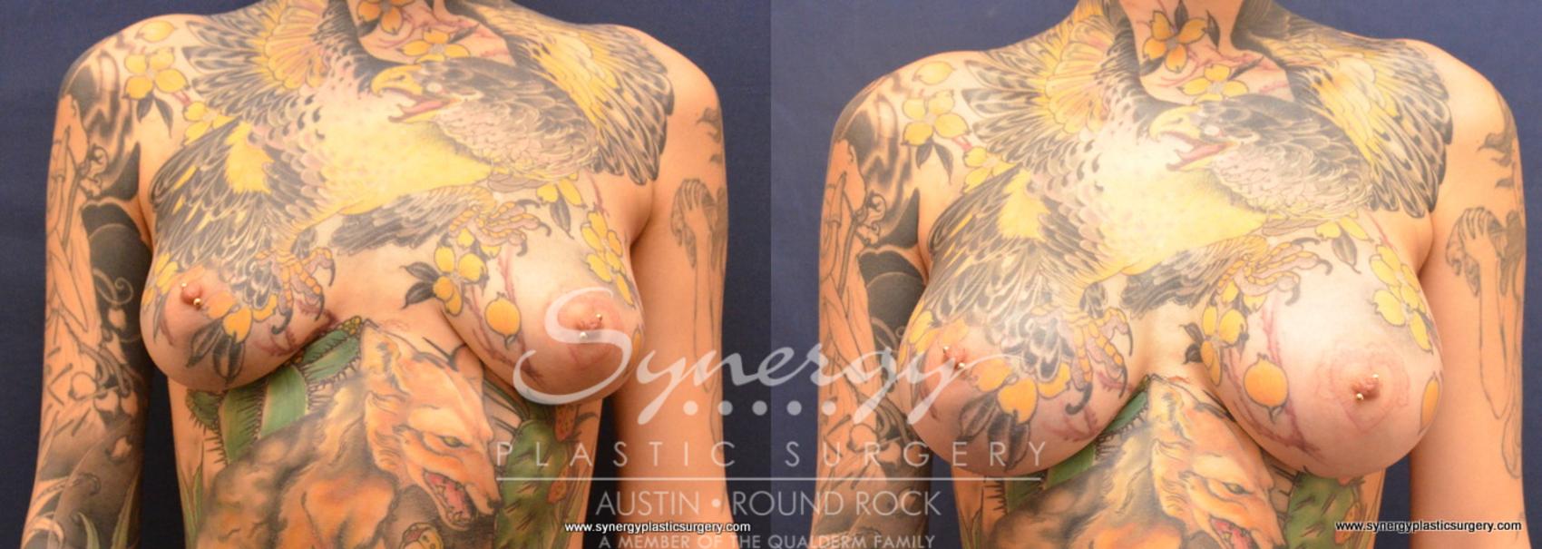 Before & After Breast Augmentation Case 669 View #1 View in Austin, TX