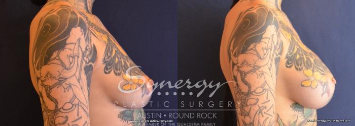 Before & After Breast Augmentation Case 669 View #3 View in Austin, TX