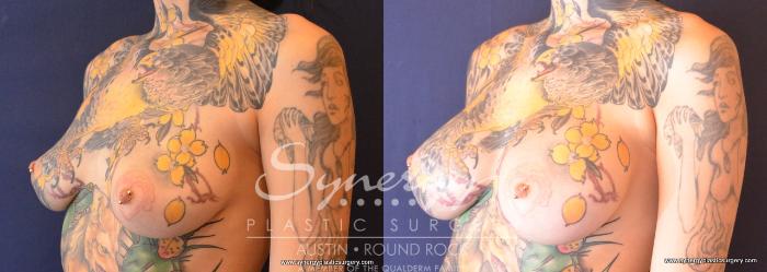 Before & After Breast Augmentation Case 669 View #4 View in Austin, TX