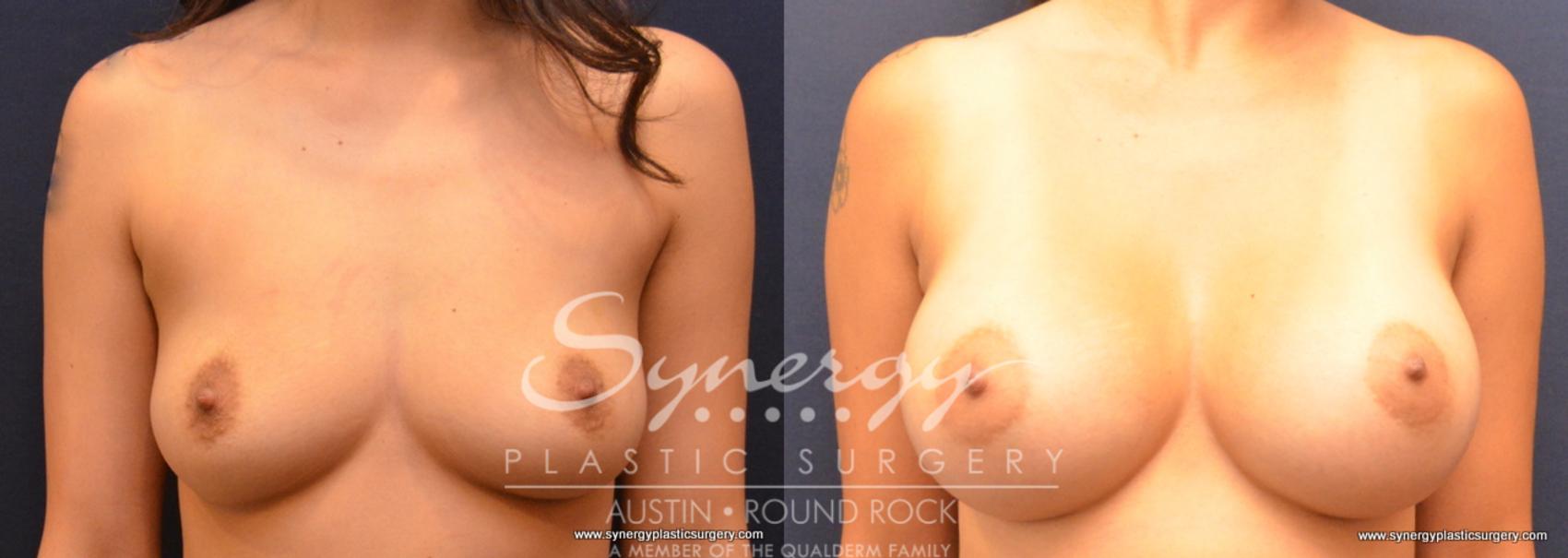 Before & After Breast Augmentation Case 670 View #1 View in Austin, TX