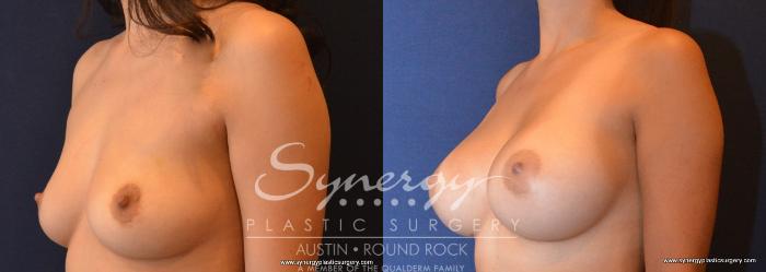 Before & After Breast Augmentation Case 670 View #2 View in Austin, TX