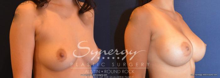 Before & After Breast Augmentation Case 670 View #4 View in Austin, TX