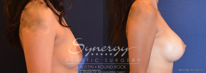 Before & After Breast Augmentation Case 670 View #5 View in Austin, TX