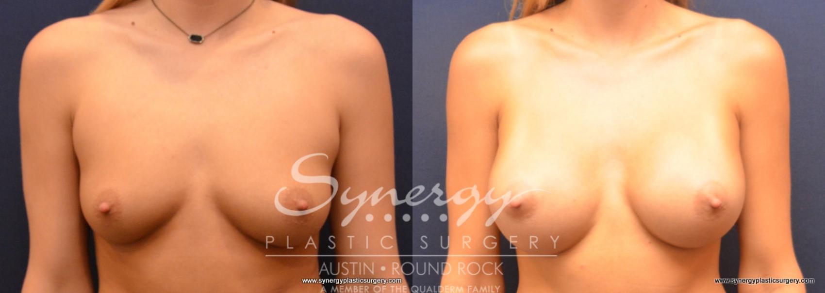 Before & After Breast Augmentation Case 671 View #1 View in Austin, TX