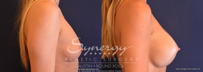 Before & After Breast Augmentation Case 671 View #3 View in Austin, TX