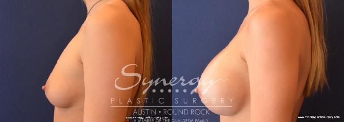 Before & After Breast Augmentation Case 671 View #4 View in Austin, TX